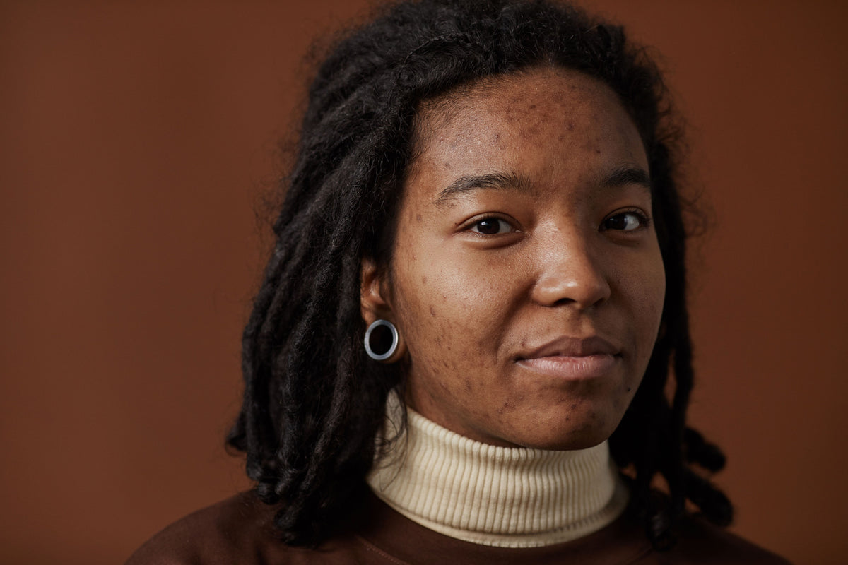 Woman with locs in a beige turtleneck with visible breakouts on her forehead and cheeks