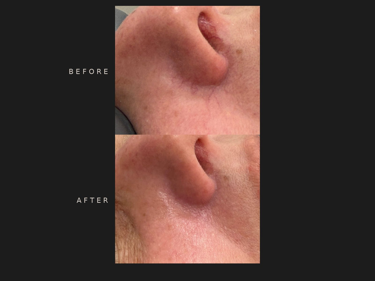 Before and after: visible vessels, one IPL treatment