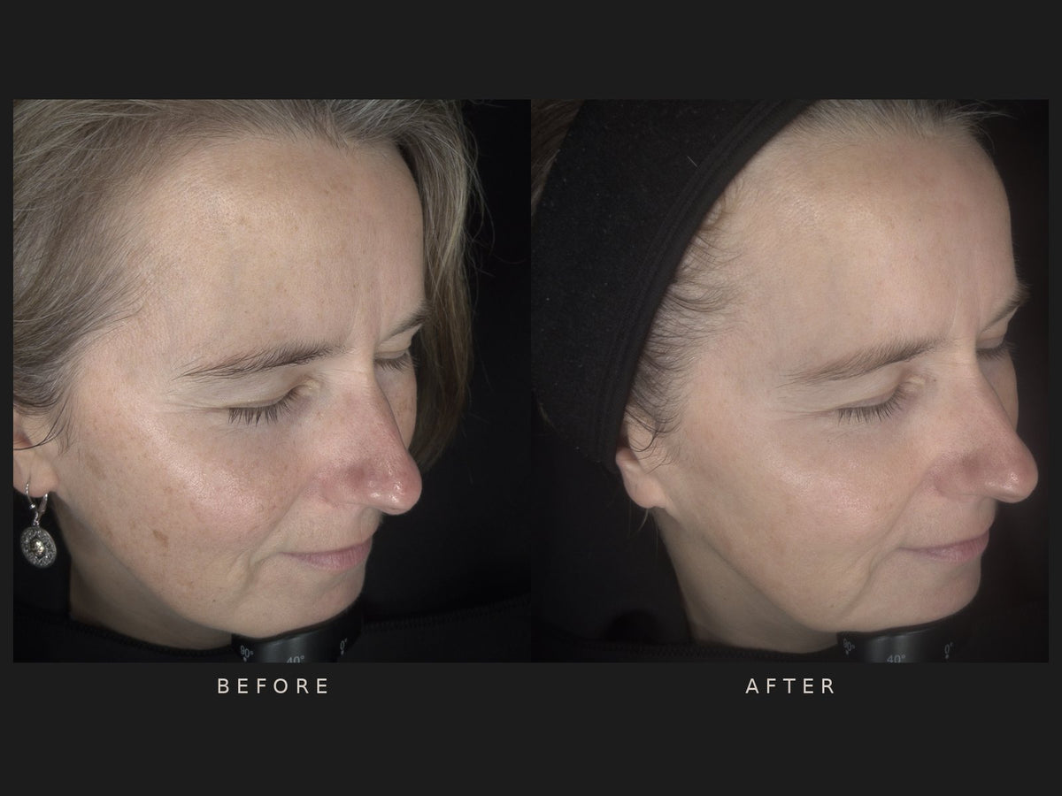 Before and after: Lisa, IPL and chemical peel