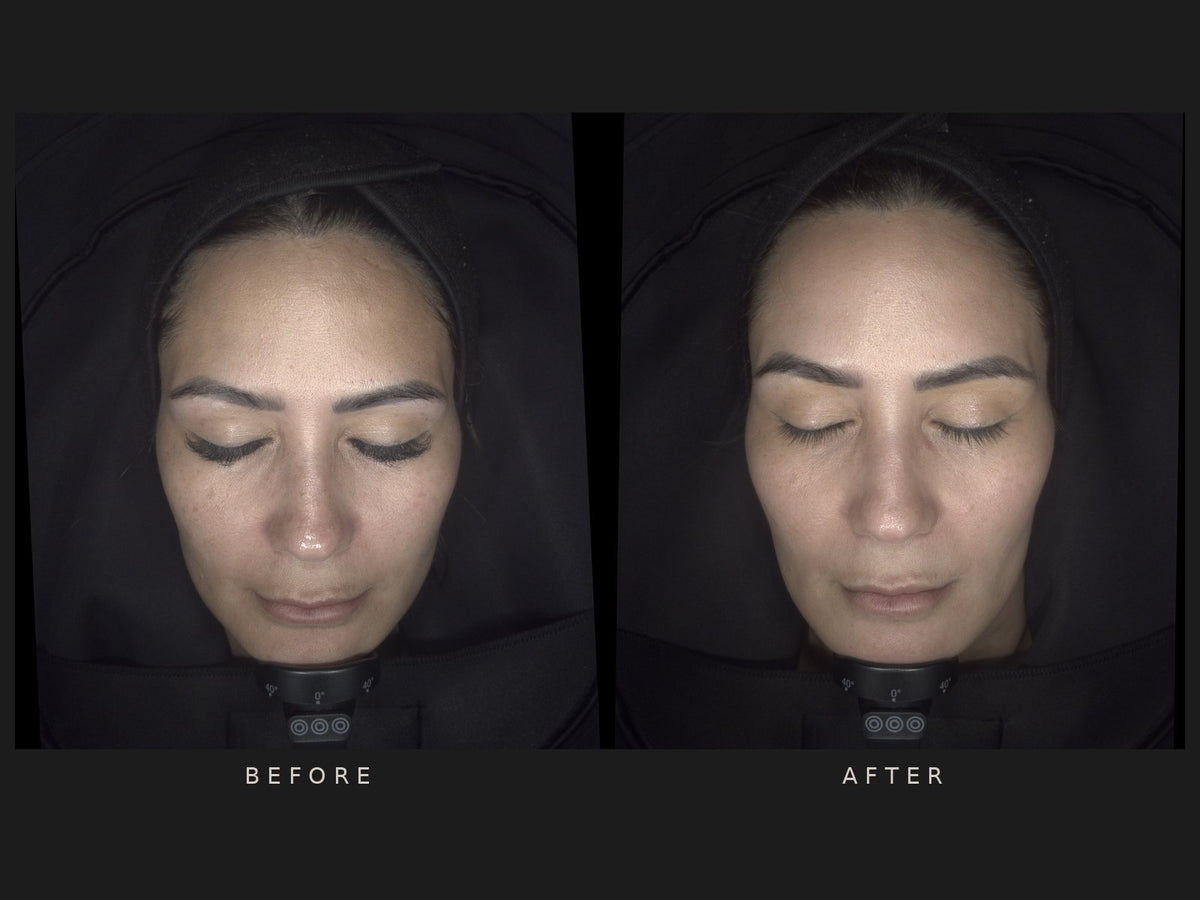 Before and after: Natashia, 3 skin needling and 2 IPL treatments