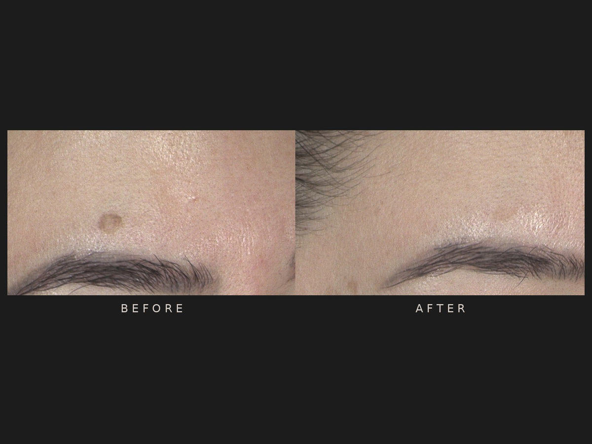 Before and after: pigment spot, one treatment