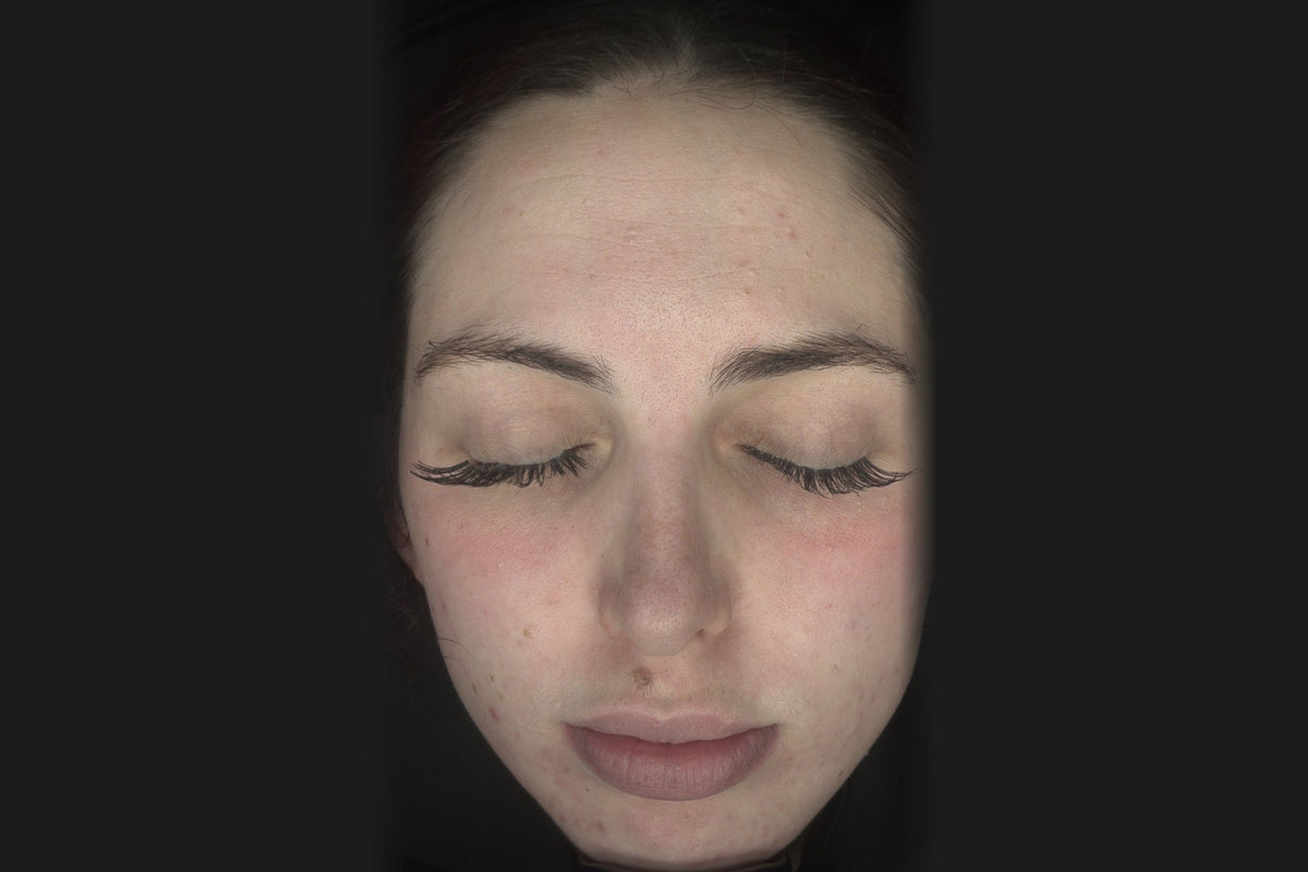 After: Izzy after a skincare routine, crystal peel, chemical peels and skin needling, front view