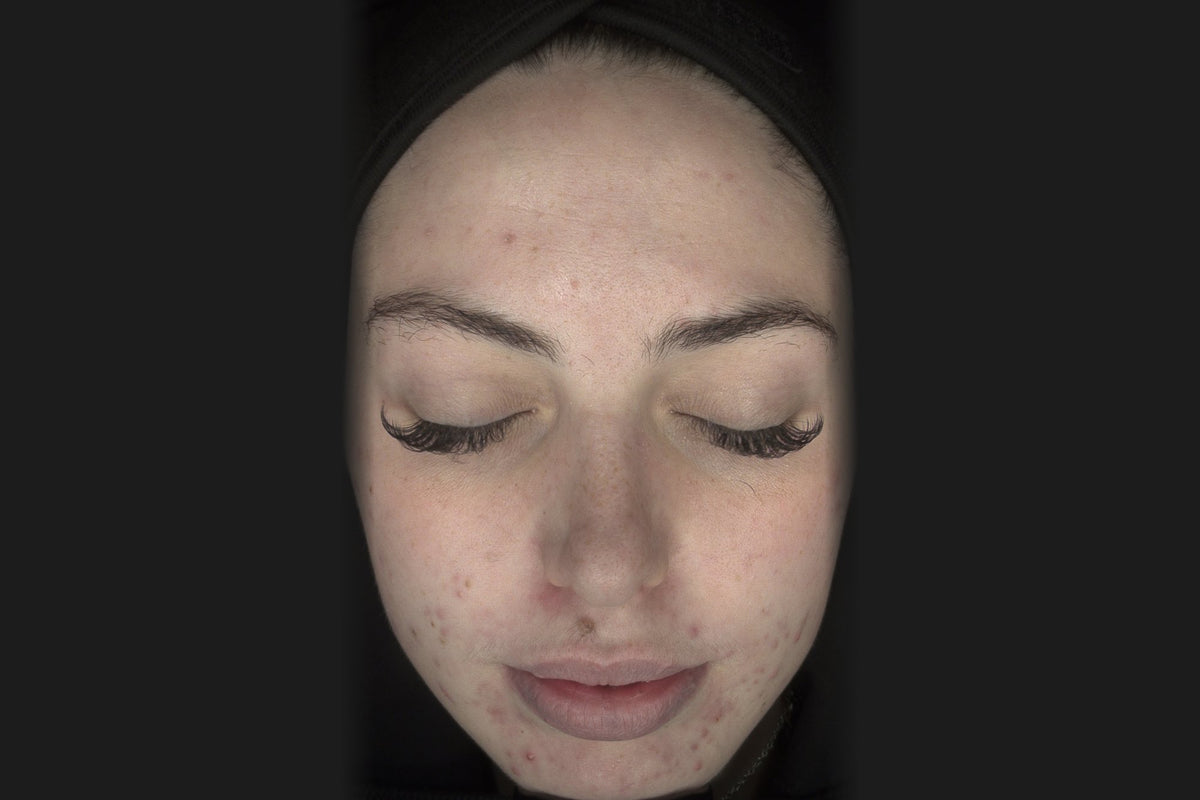 Before: Izzy, front view, acne scarring