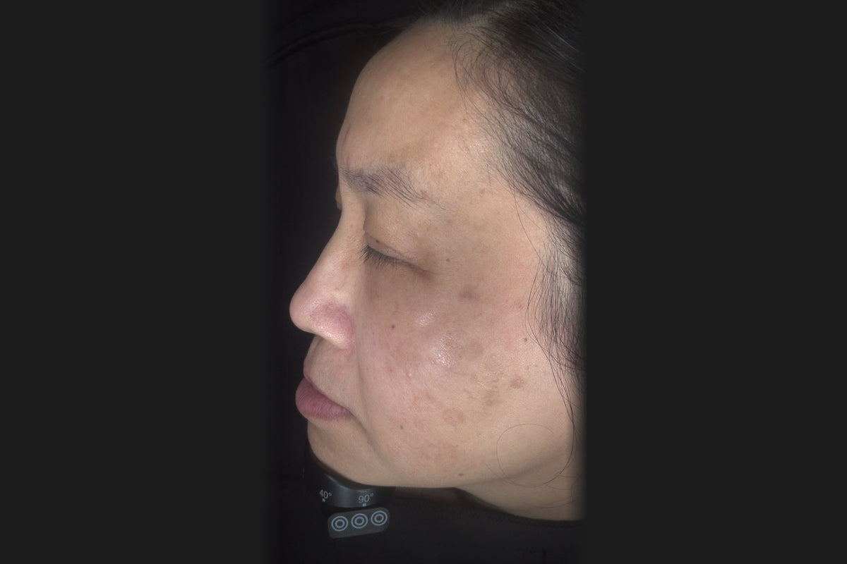 After: Ngan after 3 laser and IPL treatments, side profile, reduced pigmentation