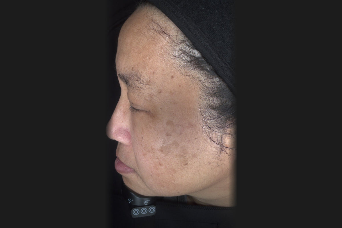 Before: Ngan, side profile, pigmentation