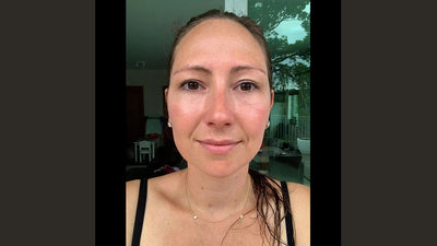 Els shares her skin story