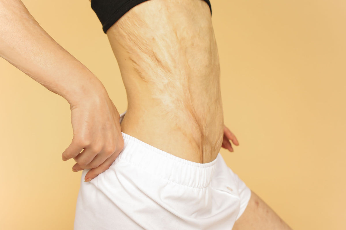 Woman's waist and hip showing stretch marks