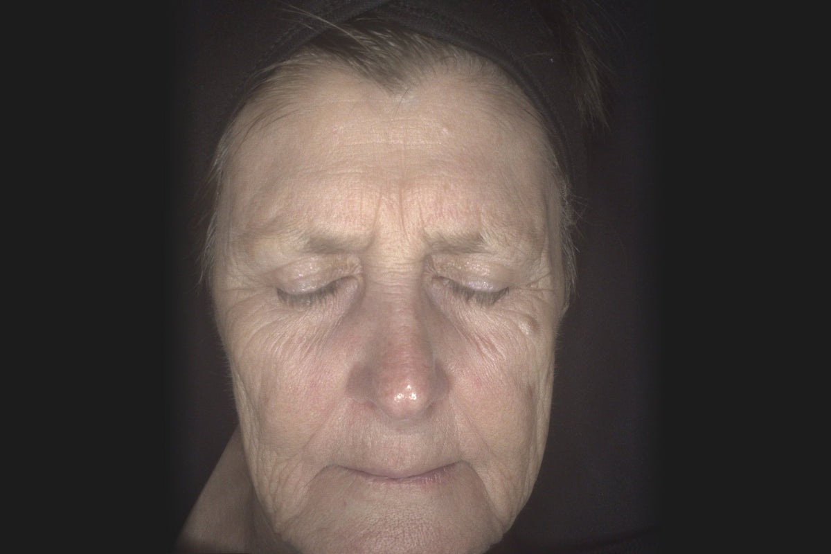 After: Colleen after 4 IPL treatments, front view