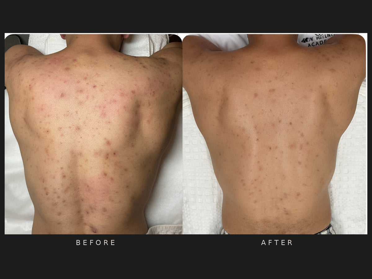 Before and after: Arjun, back, salicylic peels and extractions