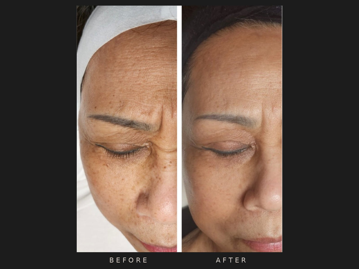 Before and after: Loan, sun damage, pigmentation and wrinkles, 9 treatments over 10 months