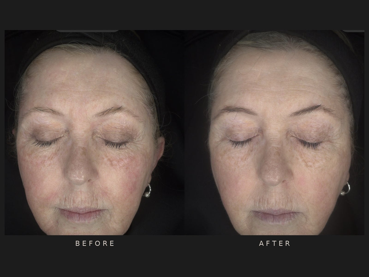 Before and after: Lou, front view