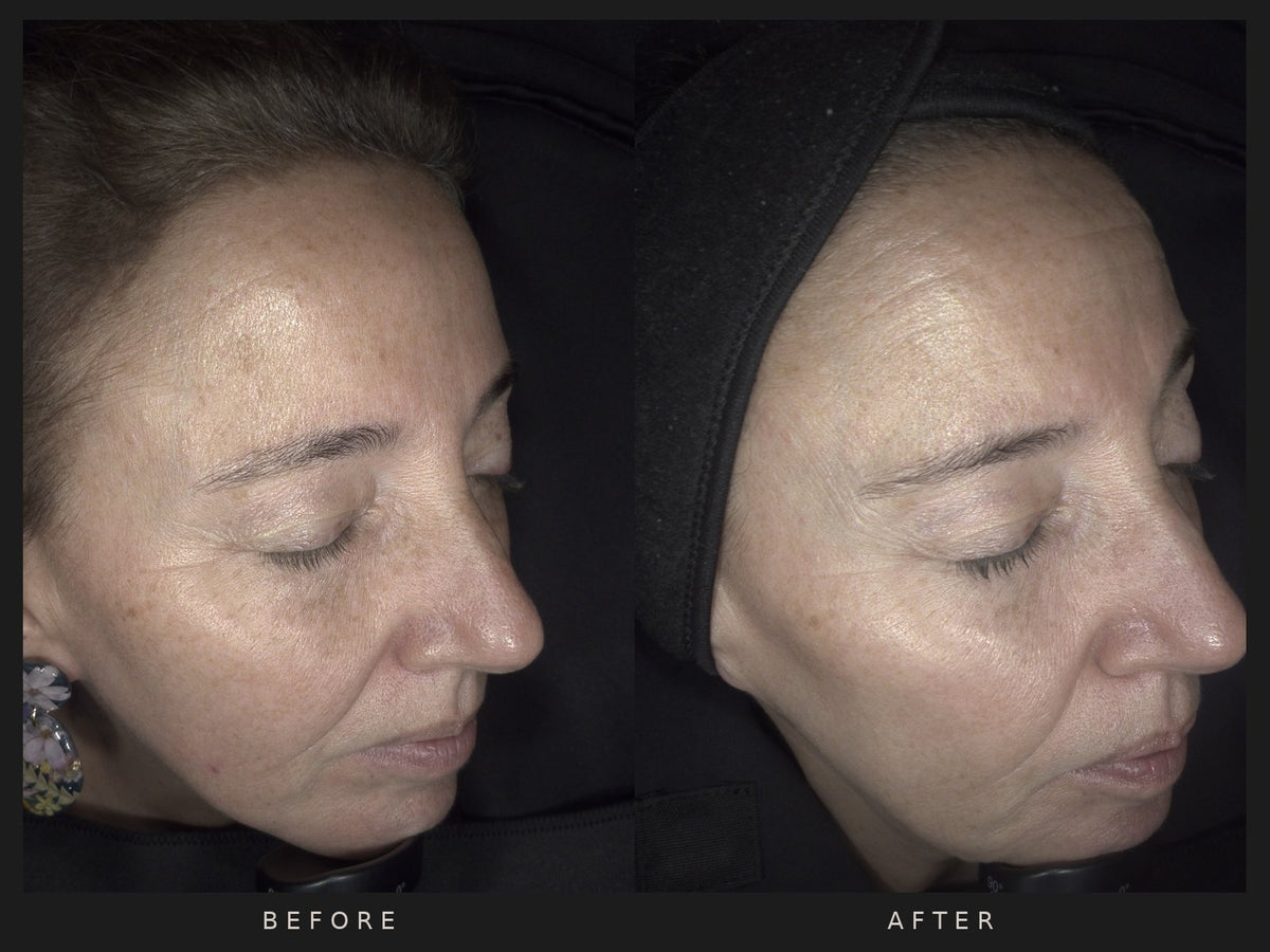 Before and after: Rachel, one IPL treatment, after photo taken one year later