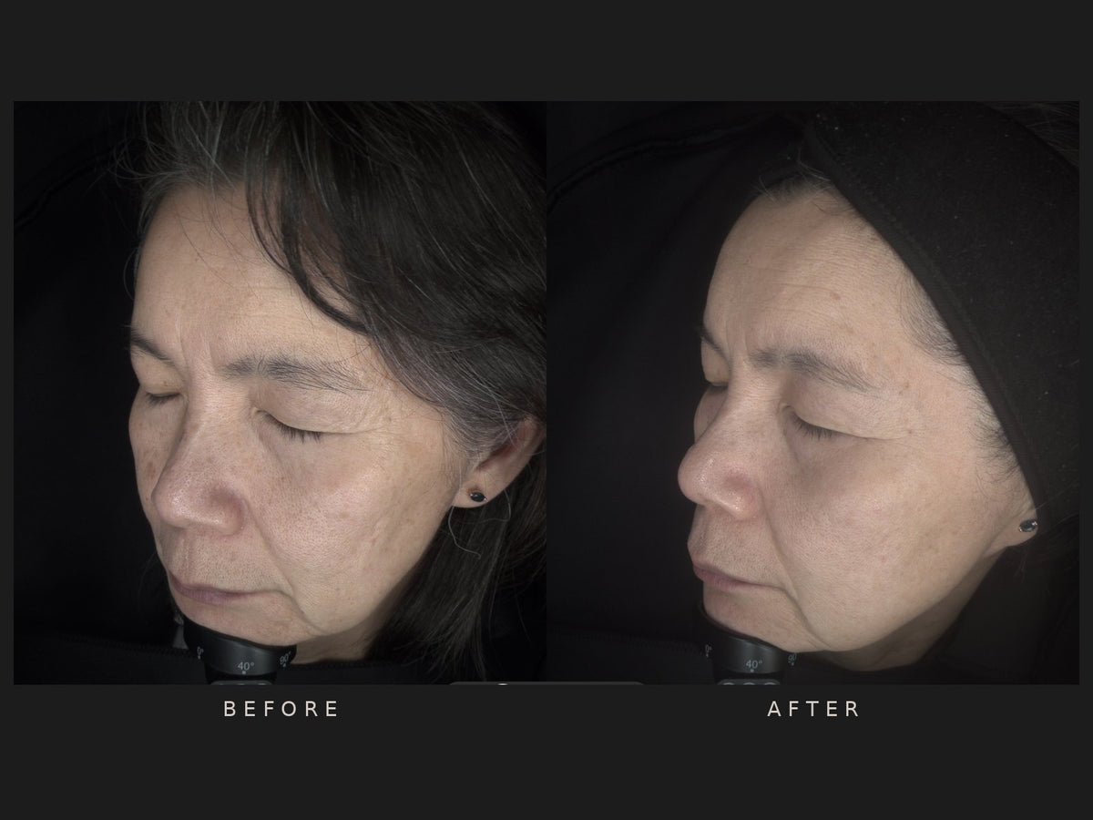 Before and after: Tanya, side profile, one year apart