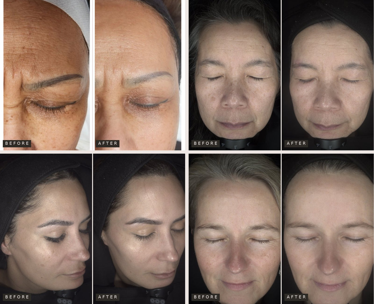 Before and after skin transformations of four Skin Wellness Academy clients