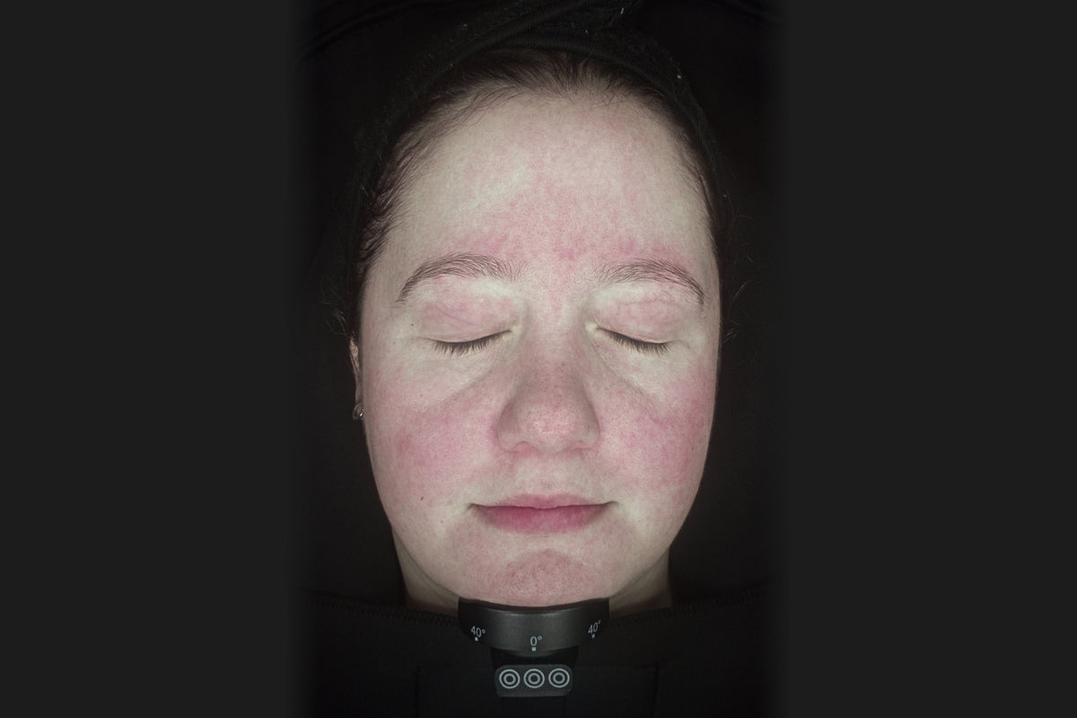 After: Marie after laser, IPL, chemical peel and oxy enzyme treatments, front view, reduced redness