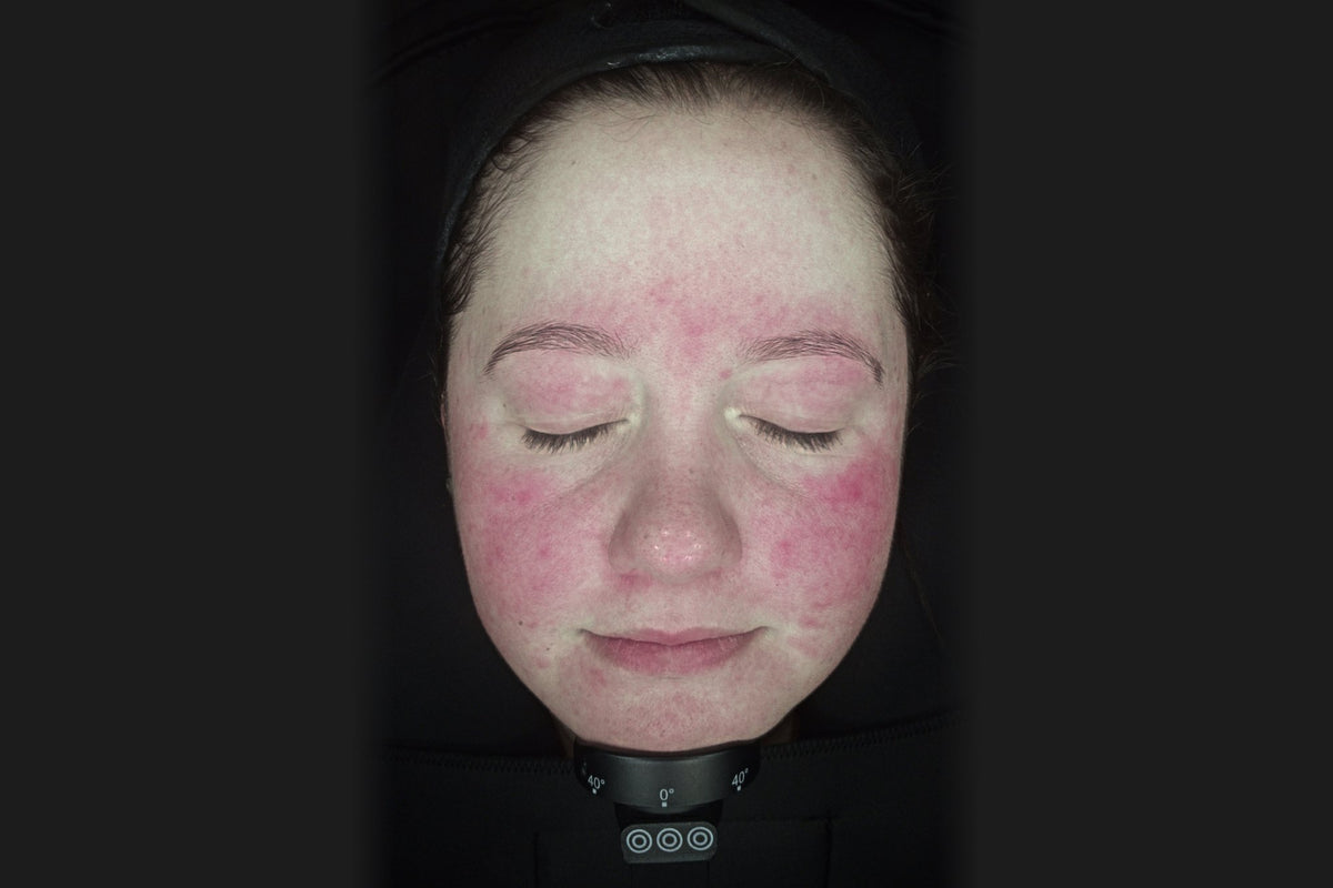 Before: Marie, front view, facial redness